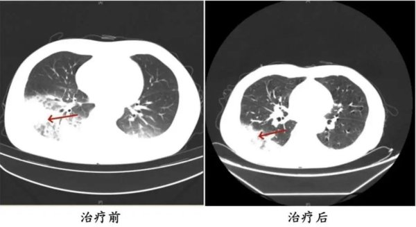 人人配 连吹3天空调致“白肺”，只因使用前忽视了这一点！
